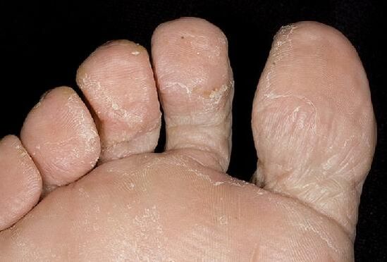 Fuß Candidiasis