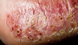 Dermatomykose