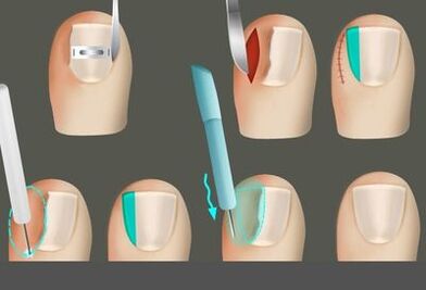 Beseitigen Sie den Nagel in Gegenwart eines Pilzes an den Beinen