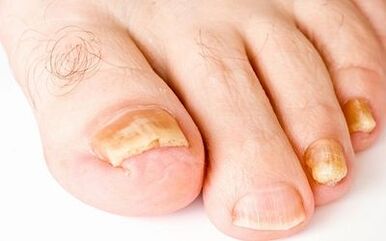 Fotografische Symptome von Nagelpilz