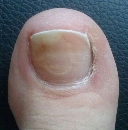 Der Pilz des Nagels am Daumen