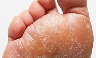 Anzeichen und Symptome von Beinen in den Beinen