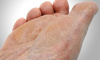 Fußpilzübertragungswege